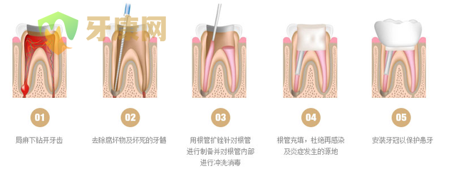 根管治疗之后牙齿的寿命