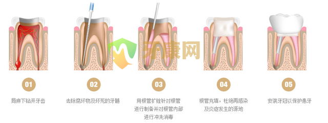 根管治疗有哪些影响