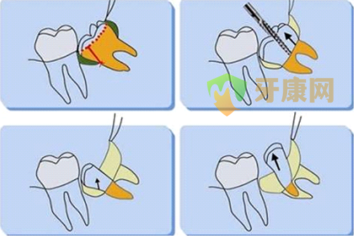 拔智齿注意事项,拔牙注意事项,智齿拔牙