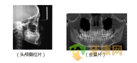 补牙前需要拍片？作用是什么？