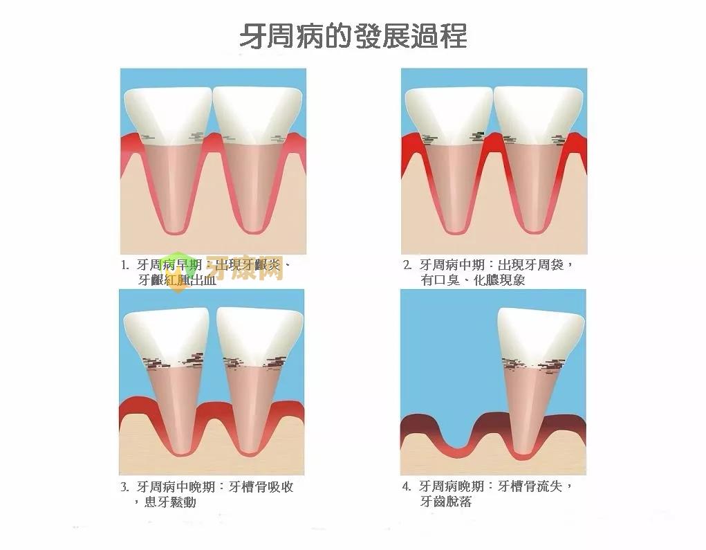 牙周病