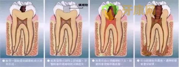 充填物周围老化