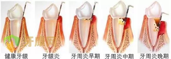 牙周治疗