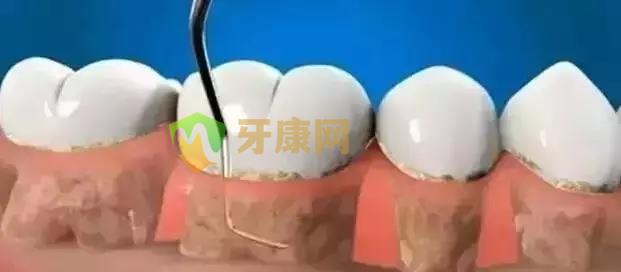 牙周病