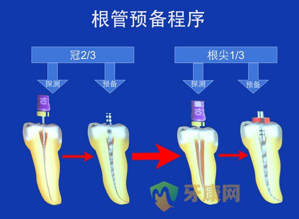 根管治疗