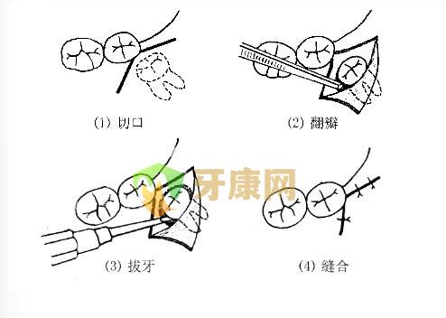 拔智齿后可以抽烟吗?