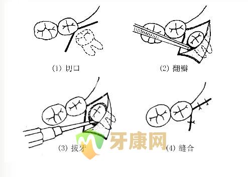 深圳儿童拔牙哪里好