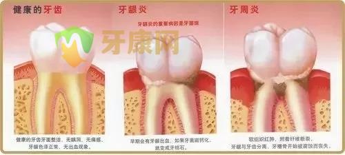 牙周炎