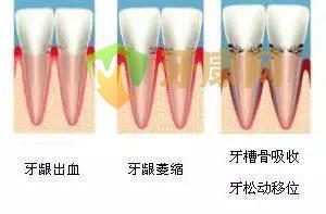 带您了解牙周炎