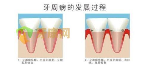 牙健网牙周炎发展过程