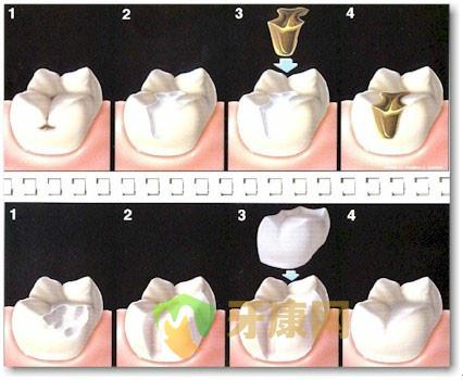 牙健网医生浅析：补牙后材料为什么会掉?