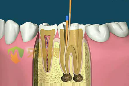 蛀牙根管治疗大概多少钱