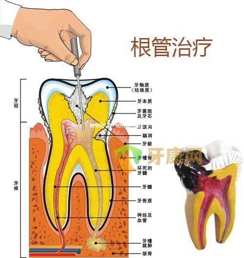 深圳根管治疗收费标准？