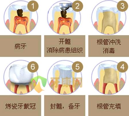 根管治疗后牙齿能用多久