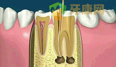 根管治疗的注意事项有哪些