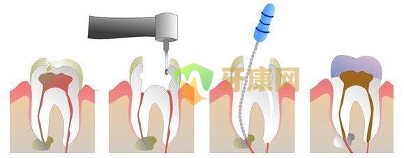 治疗牙髓炎根管治疗结果怎么样