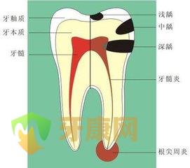 深圳哪里治疗根尖周炎结果好？