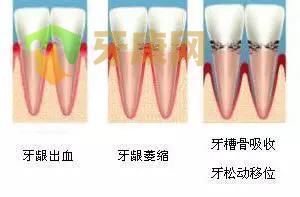 牙龈萎缩能恢复吗？