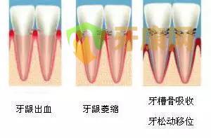 牙龈萎缩怎么办