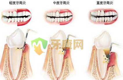 牙周炎的危害和常见症状