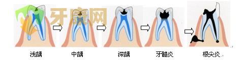 引起根尖周病的原因