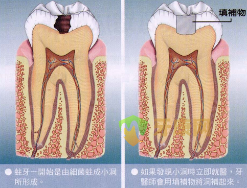 补牙后牙齿能用多久？