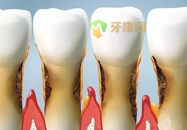 牙周病导致的牙龈萎缩的危害？