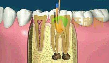 根管治疗后牙齿变黑了是怎么回事？