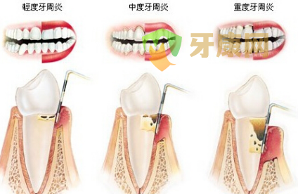 牙周炎牙齿三度松动还能治好吗？