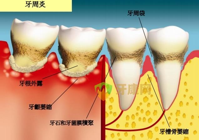 中度牙周炎怎么治疗？