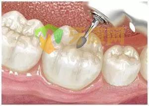 【图说】补牙的详细过程