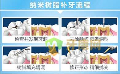 补牙缝过程图解