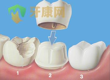 烤瓷牙是怎么修补牙缝的？