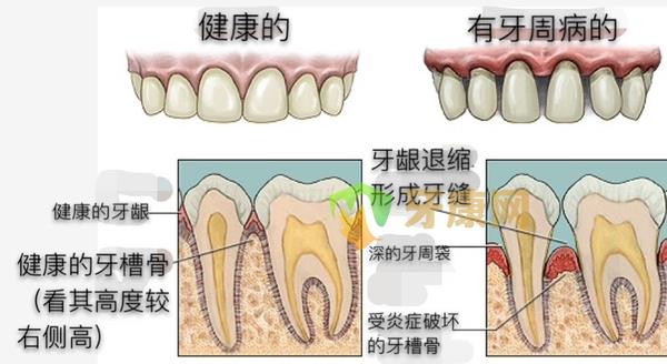 牙龈萎缩造成的牙缝大怎么修补