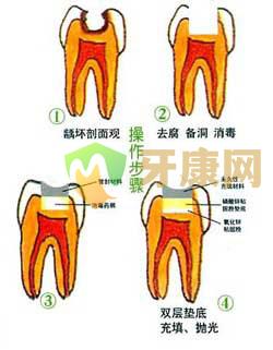 光固化树脂补牙步骤是怎样的