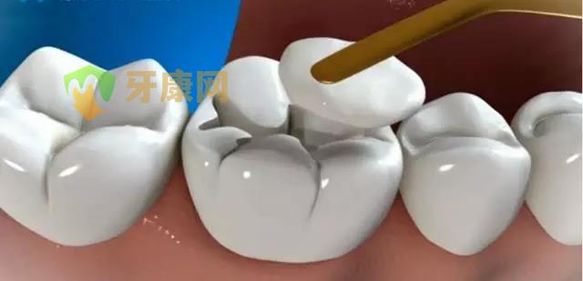 光固化树脂补牙的优缺点有哪些 