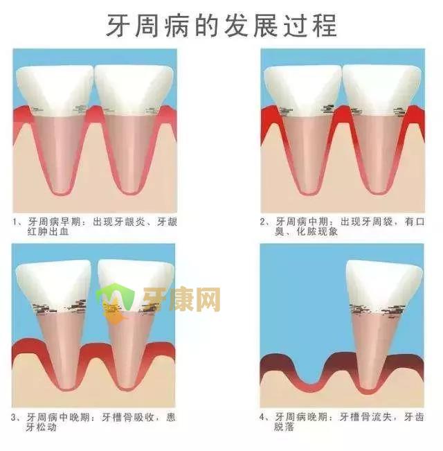 牙周病