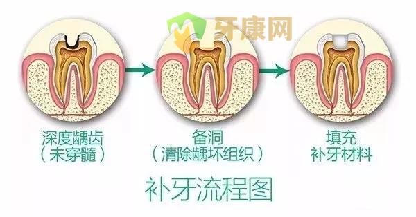 补牙