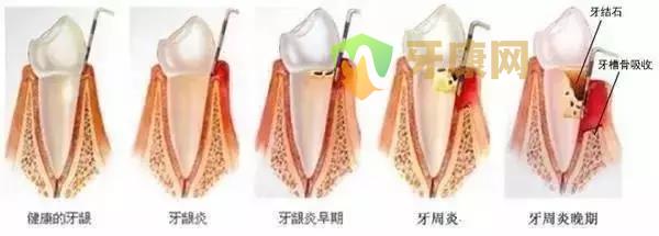 根管治疗