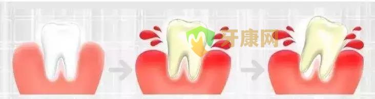 牙龈萎缩