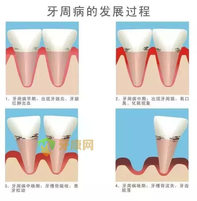 牙周病