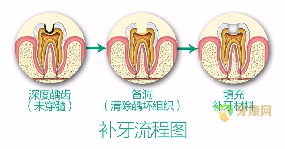 根管治疗