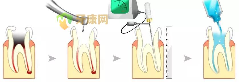 根管治疗