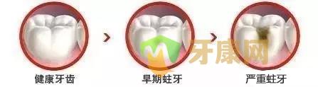 龋齿