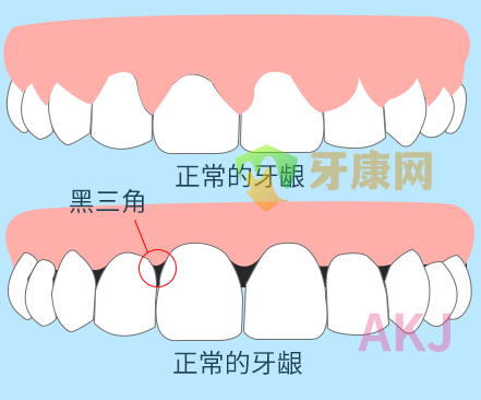 牙周炎