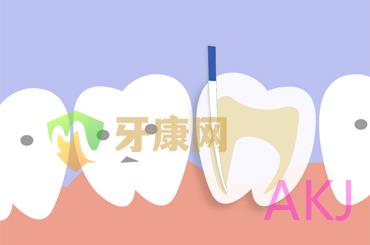根管治疗
