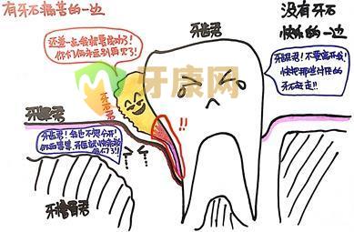 牙结石