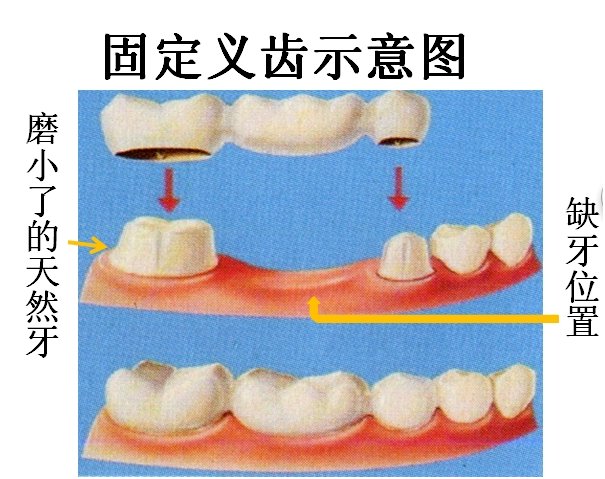 牙齿缺失后，做哪种假牙好