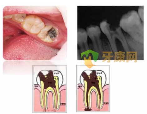 小孩牙齿上有黑斑是怎么了