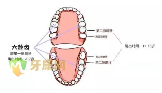 窝沟封闭